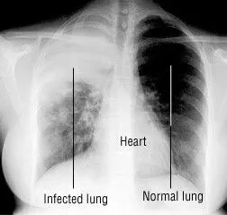 Lung Vision: X-ray-based Classification of Pulmonary Diseases