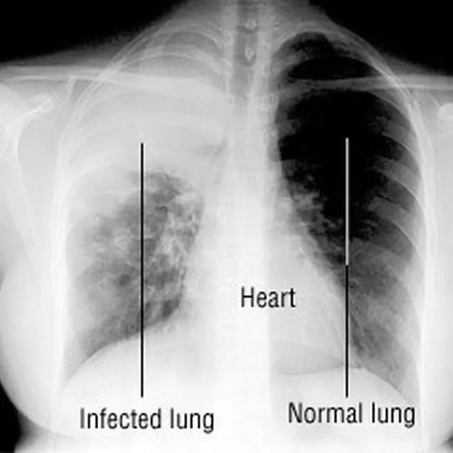 Lung Vision: X-ray-based Classification of Pulmonary Diseases
